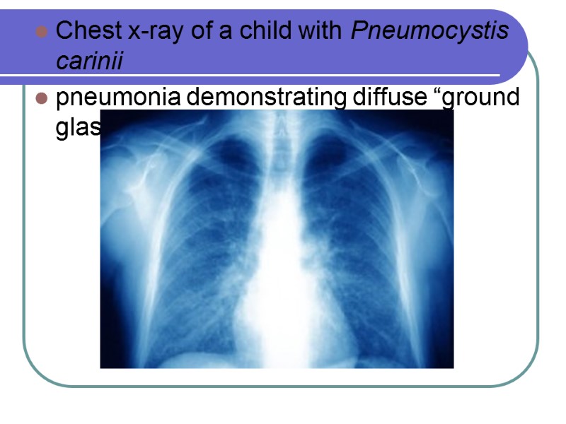 Оппортунистические инфекции Chest x-ray of a child with Pneumocystis carinii pneumonia demonstrating diffuse “ground